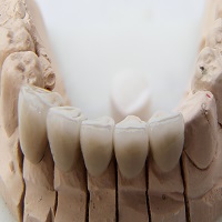 Dental Crowns and Bridges